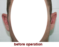 plastic-surgery-prominent-ear 